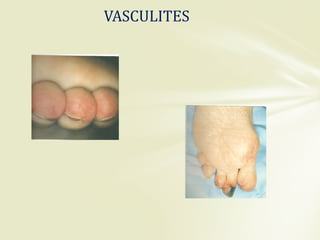 VASCULITES
 