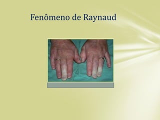 Fenômeno de Raynaud
 