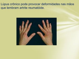 Lúpus crônico pode provocar deformidades nas mãos
que lembram artrite reumatóide.
 