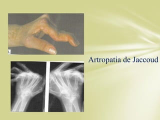 Artropatia de Jaccoud
 