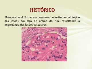 Klemperer e al. Fornecem descrevem o anátomo-patológico
das lesões em alça de arame do rim, ressaltando a
importância das lesões vasculares
HISTÓRICOHISTÓRICO
 