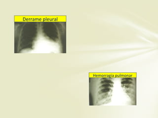 Derrame pleural
Hemorragia pulmonar
 