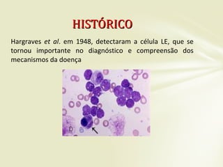 Hargraves et al. em 1948, detectaram a célula LE, que se
tornou importante no diagnóstico e compreensão dos
mecanismos da doença
HISTÓRICOHISTÓRICO
 