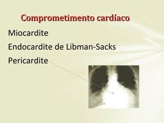Miocardite
Endocardite de Libman-Sacks
Pericardite
Comprometimento cardíacoComprometimento cardíaco
 