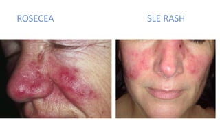 Systemic lupus erythematosis. Power point | PPTX