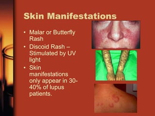 Skin Manifestations
• Malar or Butterfly
Rash
• Discoid Rash –
Stimulated by UV
light
• Skin
manifestations
only appear in 30-
40% of lupus
patients.
 