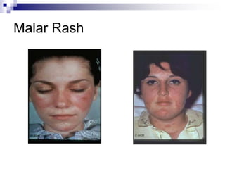 Malar Rash
 