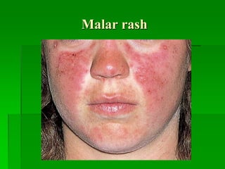 Malar rash
 