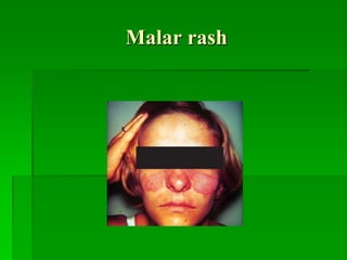Malar rash
 