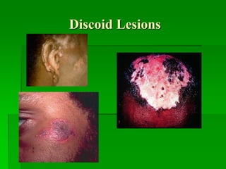 Discoid Lesions
 