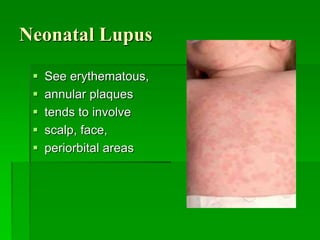 Neonatal Lupus
 See erythematous,
 annular plaques
 tends to involve
 scalp, face,
 periorbital areas
 