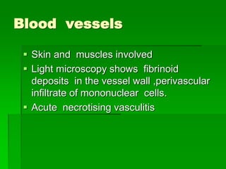 Blood vessels
 Skin and muscles involved
 Light microscopy shows fibrinoid
deposits in the vessel wall ,perivascular
infiltrate of mononuclear cells.
 Acute necrotising vasculitis
 