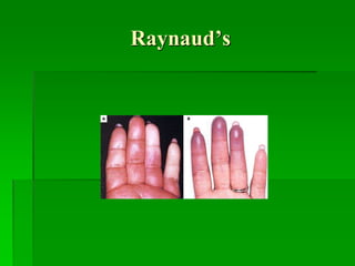 Raynaud’s
 