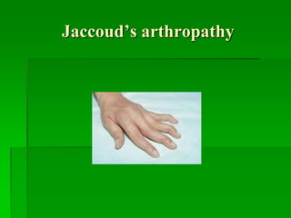 Jaccoud’s arthropathy
 