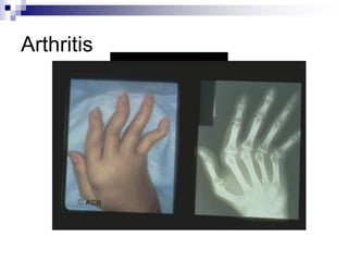 Arthritis
 