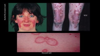 Butterfly(malar)rash
Discood rash
SCLE
 