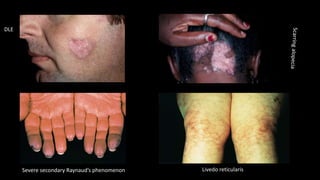 Severe secondary Raynaud’s phenomenon Livedo reticularis
DLE
 