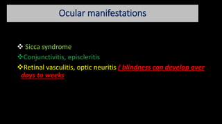 Ocular manifestations
 Sicca syndrome
Conjunctivitis, episcleritis
Retinal vasculitis, optic neuritis ( blindness can develop over
days to weeks
 