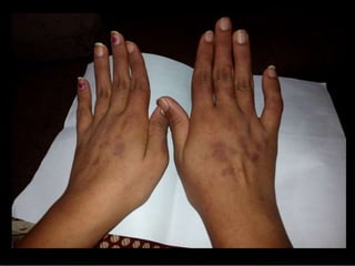 * 
*Pallor +ve 
*Jaundice –ive 
*Splinter hemorrhages –ive 
*Peri ungual erythema –ive 
*Nail fold infarct –ive 
*Joint swelling –ive 
*Proximal IPJ deformity (2nd,3rd,4th digit left hand) + 
*Reddish Plaques(atrophic and non blanchable)over 
dorsum of hands and fingers 
 