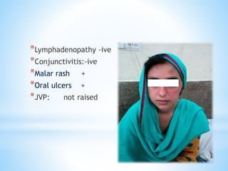 *Lymphadenopathy -ive 
*Conjunctivitis:-ive 
*Malar rash + 
*Oral ulcers + 
*JVP: not raised 
 