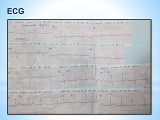 ECG 
 