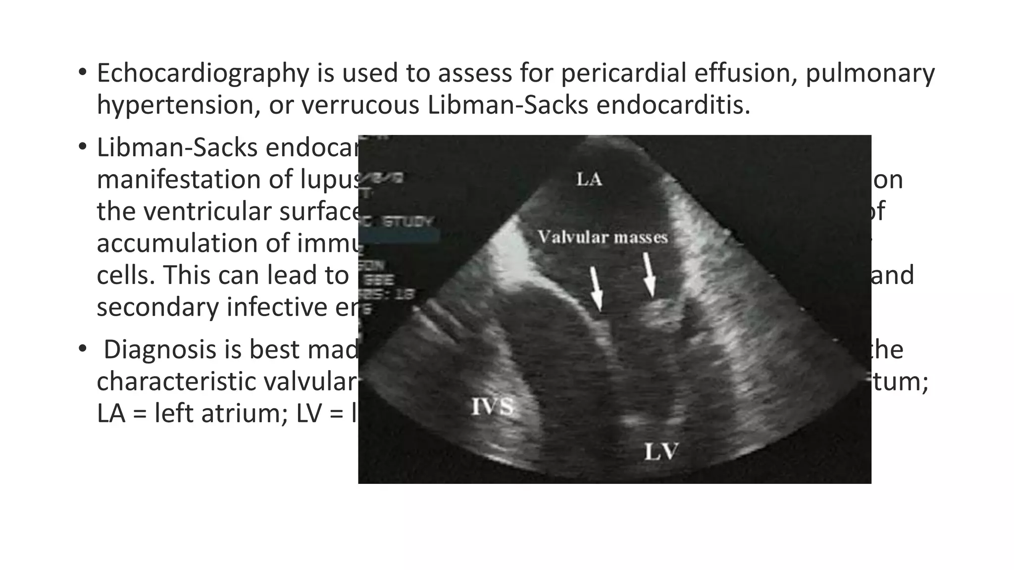 • Echocardiography is used to assess for pericardial effusion, pulmonary
hypertension, or verrucous Libman-Sacks endocarditis.
• Libman-Sacks endocarditis is the most characteristic cardiac
manifestation of lupus. It is characterized by clusters of verrucae on
the ventricular surface of the mitral valve. These lesions consist of
accumulation of immune complexes, platelets, and mononuclear
cells. This can lead to heart failure, valvular dysfunction, emboli, and
secondary infective endocarditis.
• Diagnosis is best made via echocardiography, which may reveal the
characteristic valvular masses (arrows). IVS = interventricular septum;
LA = left atrium; LV = left ventricle.
 