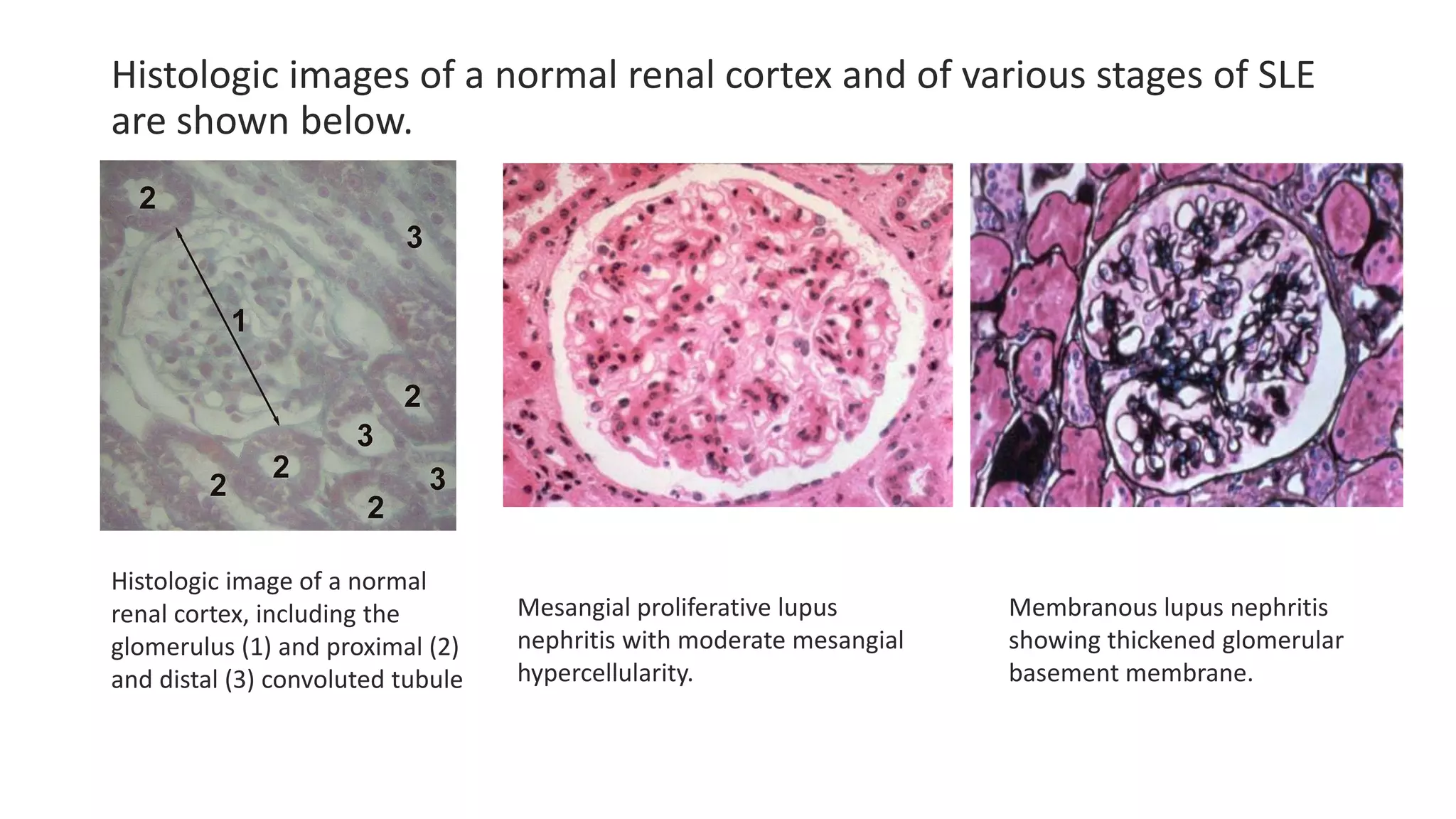 Histologic images of a normal renal cortex and of various stages of SLE
are shown below.
Histologic image of a normal
renal cortex, including the
glomerulus (1) and proximal (2)
and distal (3) convoluted tubule
Mesangial proliferative lupus
nephritis with moderate mesangial
hypercellularity.
Membranous lupus nephritis
showing thickened glomerular
basement membrane.
 