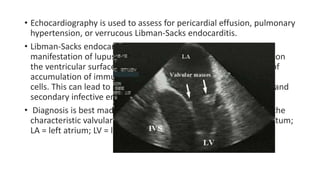 • Echocardiography is used to assess for pericardial effusion, pulmonary
hypertension, or verrucous Libman-Sacks endocarditis.
• Libman-Sacks endocarditis is the most characteristic cardiac
manifestation of lupus. It is characterized by clusters of verrucae on
the ventricular surface of the mitral valve. These lesions consist of
accumulation of immune complexes, platelets, and mononuclear
cells. This can lead to heart failure, valvular dysfunction, emboli, and
secondary infective endocarditis.
• Diagnosis is best made via echocardiography, which may reveal the
characteristic valvular masses (arrows). IVS = interventricular septum;
LA = left atrium; LV = left ventricle.
 