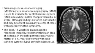 • Brain magnetic resonance imaging
(MRI)/magnetic resonance angiography (MRA)
is used to evaluate for central nervous system
(CNS) lupus white-matter changes vasculitis, or
stroke, although findings are often nonspecific
and may be absent in as many as 42% of cases
with neuropsychiatric symptoms.
• This axial, T2-weighted brain magnetic
resonance image (MRI) demonstrates an area
of ischemia in the right periventricular white
matter of a 41-year-old woman with long-
standing systemic lupus erythematosus (SLE).
 