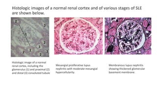 Histologic images of a normal renal cortex and of various stages of SLE
are shown below.
Histologic image of a normal
renal cortex, including the
glomerulus (1) and proximal (2)
and distal (3) convoluted tubule
Mesangial proliferative lupus
nephritis with moderate mesangial
hypercellularity.
Membranous lupus nephritis
showing thickened glomerular
basement membrane.
 