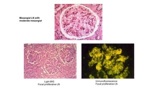 Mesangial LN with
moderate mesangial
hypercellularity
Immunofluorescence:
Focal proliferative LN
Light M/E:
Focal proliferative LN
 