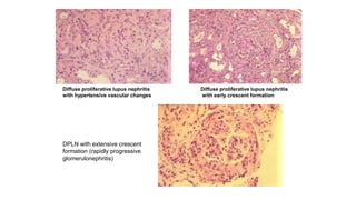 Diffuse proliferative lupus nephritis
with hypertensive vascular changes.
Diffuse proliferative lupus nephritis
with early crescent formation
DPLN with extensive crescent
formation (rapidly progressive
glomerulonephritis)
 