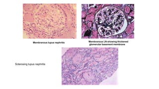 Membranous LN showing thickened
glomerular basement membrane.
Membranous lupus nephritis
Sclerosing lupus nephritis
 