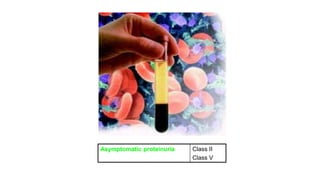 Class II
Class V
Asymptomatic proteinuria
 