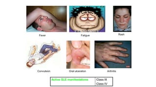 Fever Fatigue Rash
Arthritis
Oral ulceration
Convulsion
Class III
Class IV
Active SLE manifestations
 