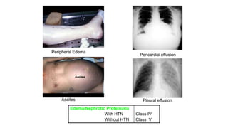 Peripheral Edema
Pericardial effusion
Pleural effusion
Ascites
Class IV
Class V
Edema/Nephrotic Proteinuria
With HTN
Without HTN
 