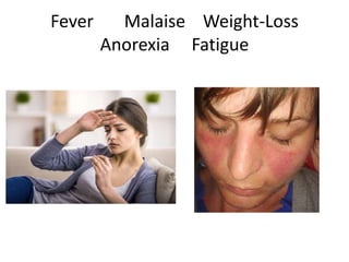 Fever Malaise Weight-Loss
Anorexia Fatigue
 
