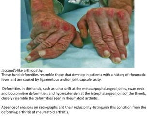 Jaccoud’s-like arthropathy.
These hand deformities resemble those that develop in patients with a history of rheumatic
fever and are caused by ligamentous and/or joint capsule laxity.
Deformities in the hands, such as ulnar drift at the metacarpophalangeal joints, swan neck
and boutonnière deformities, and hyperextension at the interphalangeal joint of the thumb,
closely resemble the deformities seen in rheumatoid arthritis.
Absence of erosions on radiographs and their reducibility distinguish this condition from the
deforming arthritis of rheumatoid arthritis.
 