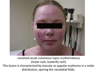Localized acute cutaneous lupus erythematosus
(malar rash, butterfly rash)
This lesion is characterized by macular or papular erythema in a malar
distribution, sparing the nasolabial folds.
 