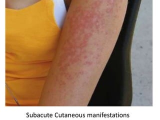 Subacute Cutaneous manifestations
 
