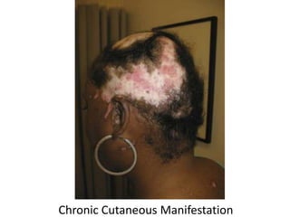Chronic Cutaneous Manifestation
 