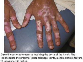 Discoid lupus erythematosus involving the dorsa of the hands. The
lesions spare the proximal interphalangeal joints, a characteristic feature
of lupus-specific rashes.
 