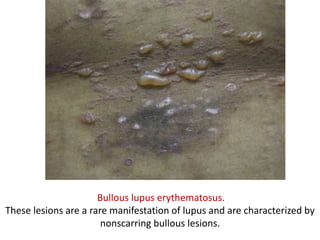 Bullous lupus erythematosus.
These lesions are a rare manifestation of lupus and are characterized by
nonscarring bullous lesions.
 