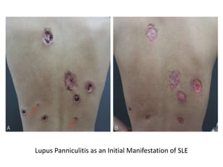Lupus Panniculitis as an Initial Manifestation of SLE
 