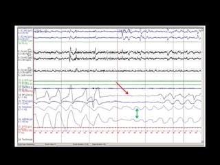 Sleep Study Interpretation | PPT