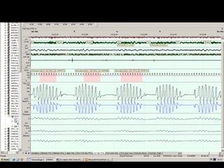 Sleep Study Interpretation | PPT