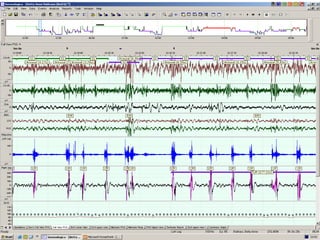 Sleep Analysis Study Sleep Study Interpretation | PPT
