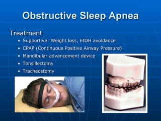 Obstructive Sleep Apnea Treatment Supportive: Weight loss, EtOH avoidance CPAP (Continuous Positive Airway Pressure) Mandibular advancement device Tonsillectomy Tracheostomy 