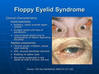 Floppy Eyelid Syndrome Clinical Characteristics Eyelid hyperlaxity Rubbery, easily everted upper eyelids Eyelash ptosis with loss of parallelism Loss of tarsal elastin due to upregulation of elastin degrading enzymes Papillary conjunctivitis Chronic ocular irritation, worse upon waking  SPK, mucoid discharge common Rubbing on pillow case Should be suspected in any obese pt with a chronic red eye 