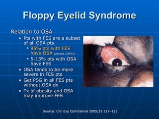 Floppy Eyelid Syndrome Relation   to OSA Pts with FES are a subset of all OSA pts 96% pts with FES have OSA  (almost 100%!) 5-15% pts with OSA have FES OSA tends to be more severe in FES pts Get PSG in all FES pts without OSA dx Tx of obesity and OSA may improve FES 